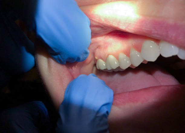 Best Emergency Gum Treatment in Elkridge, MD