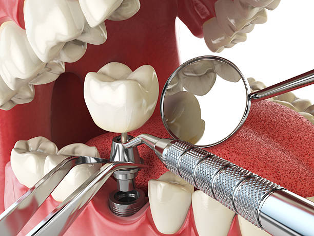 Best Emergency Denture Repair in Elkridge, MD